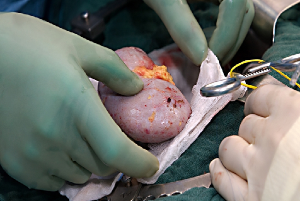 Kidney Transplantation