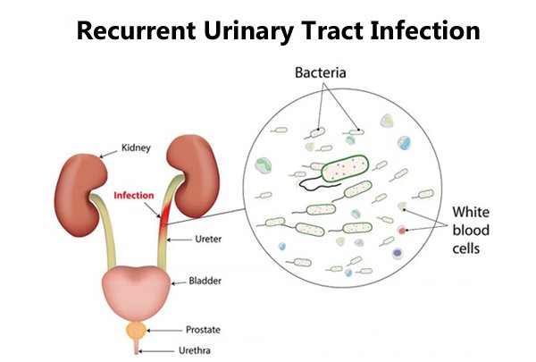 Infections of Kidney and Urinary Tract