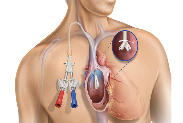 Permcath Insertion