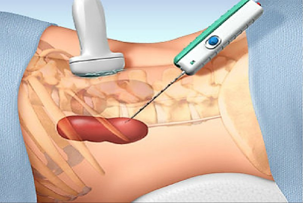 Renal Biopsy